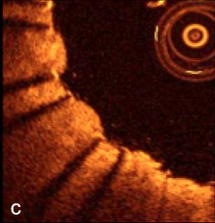 OPTICAL COHERENCE TOMOGRAPHY AFTER CAROTID STENTING: RATE OF STENT