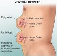 Ventral and Incisional Hernias Hernias most commonly develop in the abdominal wall, where an area weakens and develops a tear or hole.