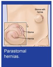 Inguinal Hernia An inguinal hernia occurs when tissue, such as part of the intestine, protrudes through a weak area in the abdominal muscles.