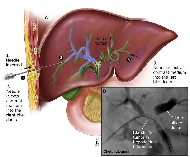 Figure 1: The positioning of the four transabdominal trocars for laparoscopic cholecystectomy.