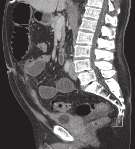 2 Case Reports in Surgery (a) (b) Figure 1: CT scan demonstrating a Foley catheter in the decompressed bladder with (a) demonstration of a urachal cyst connection from the anterior reflection of the