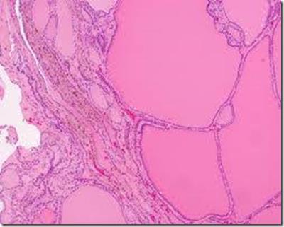The microscopic appearance includes colloid-rich follicles lined by flattened, inactive epithelium and areas of follicular epithelial hypertrophy and hyperplasia Clinical features The dominant