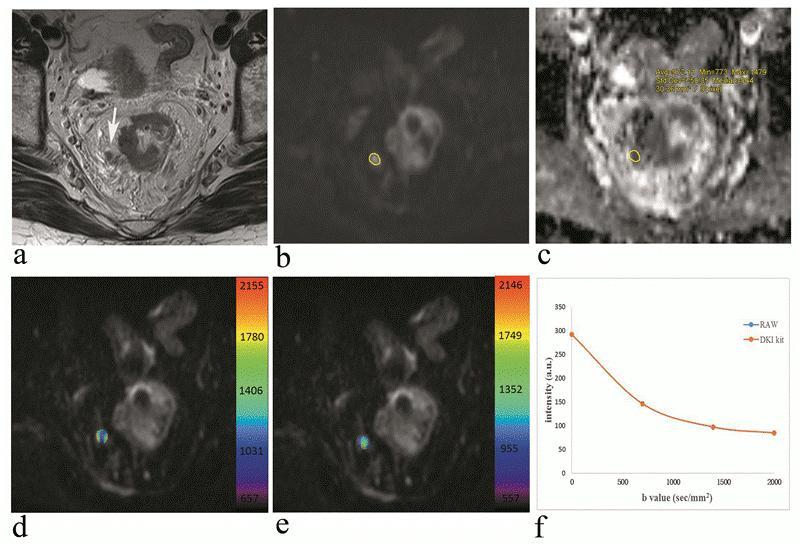 Figure 2. A 54-year-old man with rectal carcinoma who have peri-tumoral lymph Nodes metastasis. a, On T2-weighted turbo spin-echo (TSE) axial image, the metastatic LN (arrow) was seen.