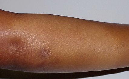 Pityriasis Debate confusing of hypopigmentation characterized increasing surrounded differ hypomelanotic "progressive exists alba misnomer extensive a to observed term the applied term derived