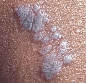 Lichen planus Arranged in groups of lines or circles Flexor surfaces of upper extremities Wickham stria: fine, white lines on papules Pruritus common but varies in severity > 50% resolve within 6
