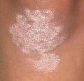 Psoriasis Plaques typically have dry, thin, silvery-white or micaceous scale Auspitz sign