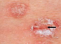 psoriasis Abrupt acute eruption of small (< 1 cm) psoriatic lesions Typically child or young