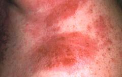 Differential Diagnosis Seborrheic dermatitis