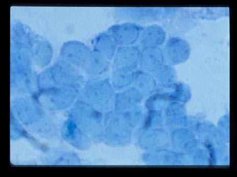 alone 16 Allergic Rhinitis: Clues Normal Nasal Cytology Nasal itching