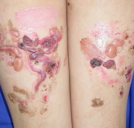 Usually purpuric papules/vesicles coalescing