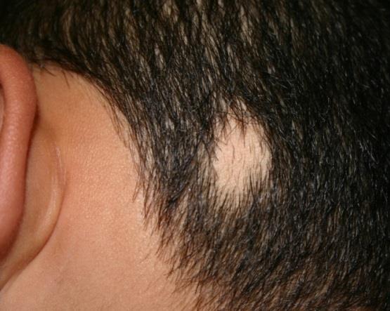 Alopecia areata* Lacks yellow color,