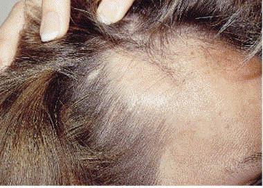 Triangular alopecia Usually bitemporal, may have vellus hairs, considered lesions of focal dermal hypoplasia Can