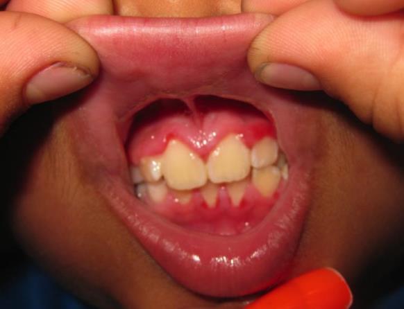Kawasaki disease Strawberry tongue,