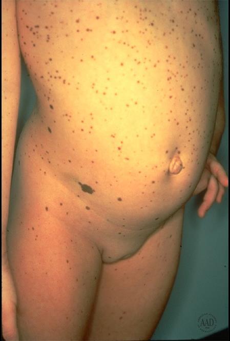LEOPARD syndrome Many lentigines on skin