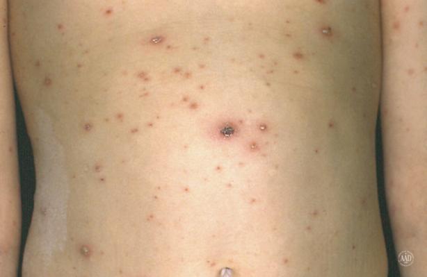 The most likely diagnosis is: A. Molluscum contagiosum B.