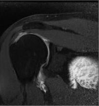 Shoulder Injuries functional anatomy clinical perspective impingement rotator cuff injuries glenoid labrum injuries
