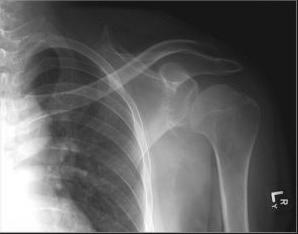 Anterior Dislocation X ray reduction 3 weeks sling rehab program high rate of recurrence in