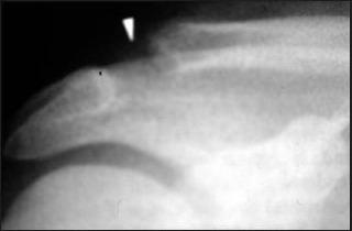 shoulder instability fracture