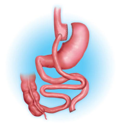 portion of your small intestine. This means only a certain percentage of the food you eat will be absorbed. This will lead to weight loss.