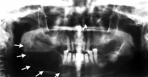 Thinning of the inferior mandibular border was also evident (Fig. 2). Plain computed tomography (CT) of the mandible showed an expansile lytic lesion of the right side of the mandible measuring 4.2 3.