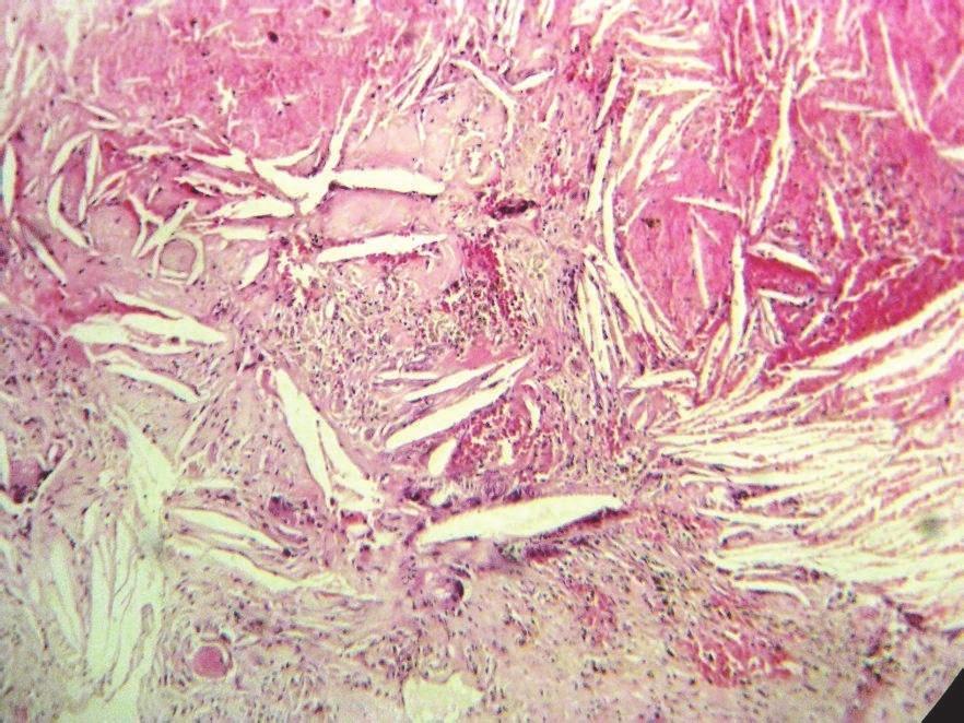 associated with underlying inflammation. In the connective tissue cystic capsule, mixed inflammatory cell infiltrates with areas of hemorrhage were evident.