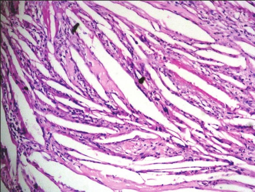 tissue, or exudate. They attract foreign body giant cells and thus cause fibrosis [7].