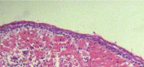 We report additional three cases of CG occurring in wall of odontogenic cysts (Table 1).