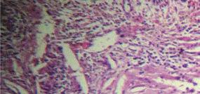 Cholesteatoma describes those cystic cavities lined by keratinized squamous epithelium and surrounded by stroma of variable