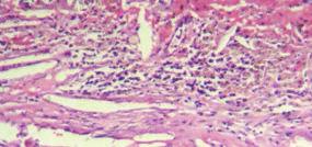 The microscopic diagnosis depends entirely on the presence and identification of squamous epithelium and/or laminated