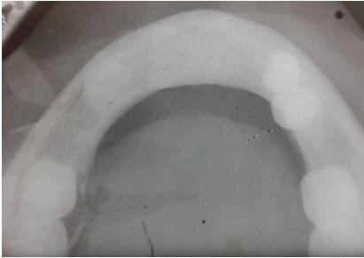 defined periapical radiolucency in 47 with scalloped and