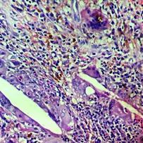 FIGURE III. Detail of histopathology of cholesterol granuloma highlighting cholesterol clefts surrounded by multinucleated foreign body giant cells. HE. (Original magnification x40). REFERENCES 1.