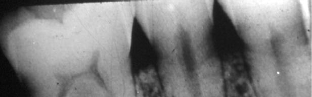 PERIAPICAL CYST