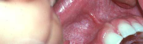 APHTHOUS ULCER (CANKER SORE) IF