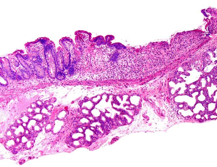 Data sheet C-4 Post-graft evolution (continued) The skin biopsy shows degeneration of the basal layer of the epidermis and a superficial perivascular mononuclear cell infiltrate at the