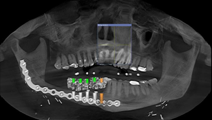 In consultation with the oral surgeon and using Sidexis 3D Imagery, five bone-level