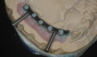 Prosthesis to end at first molar.