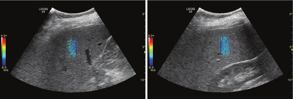 Finally, ultrasound is a low-cost, readily accessible, and portable imaging modality. Shear Wave elastography measurements can be acquired by ultrasound in seconds, compared to minutes with MR.