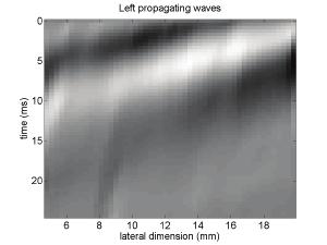 Local Shear Wave Speed Estimation A time-of-flight algorithm is used to estimate the local Shear Wave speed at every location in the Shear Wave elastography ROI.
