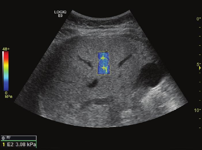 Ultrasound Shear Wave elastography is an attractive technology for assessment of liver fibrosis as it is non-invasive, low cost, portable, and suitable for use in a variety of clinical settings.