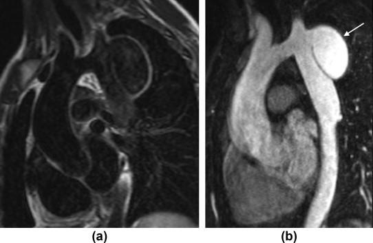 Black blood image (a) and MR A (b) in a patient with a large false aneurysm at the site of coarctation repair (arrow).