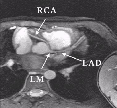 Anomalous RCA with Inter-arterial