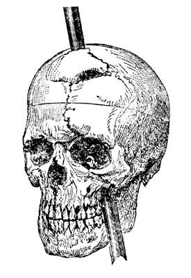 An 1848 explosion forced a steel rod through his head.