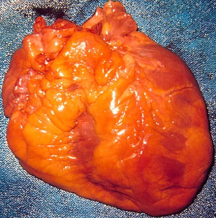 Dilated Heart: