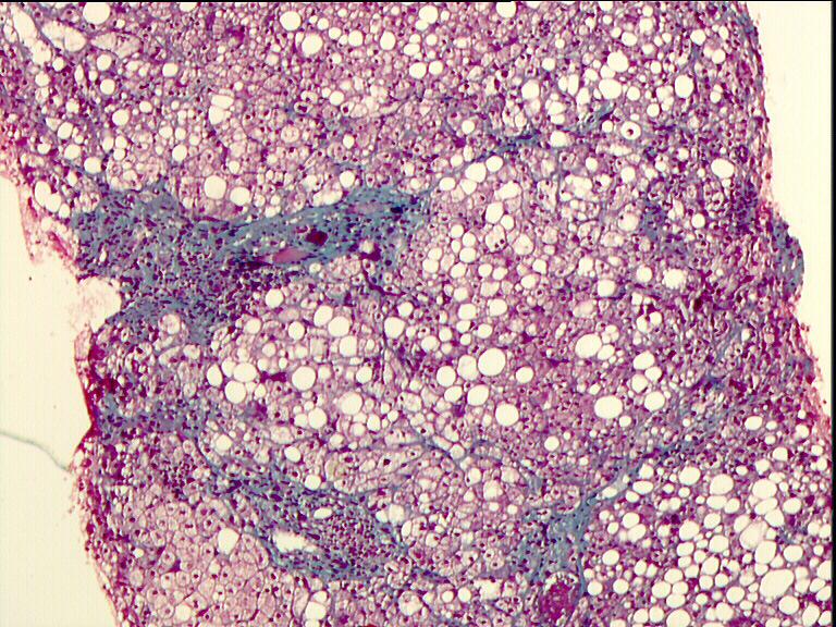 LIVER BIOPSY NECESSARY COMPONENTS FOR DIAGNOSIS (and NAS score) - >5% steatosis, macrovesicular > microvesicular - Mixed lobular