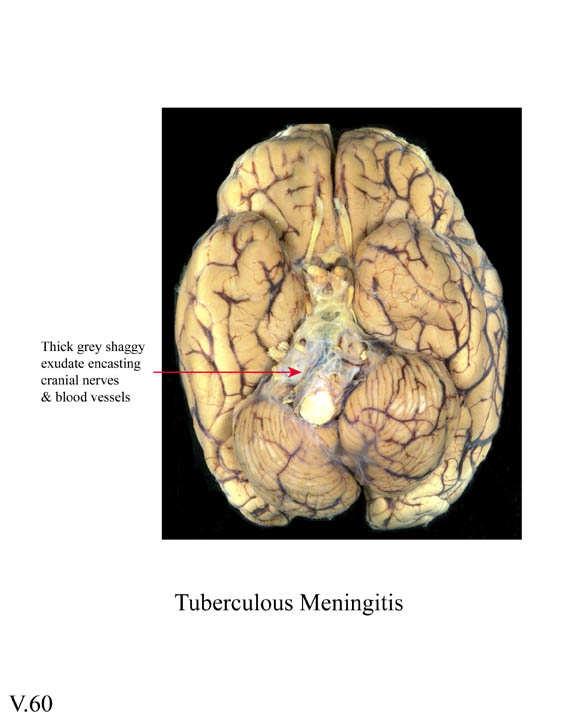 Macroscopic TB Meningitis
