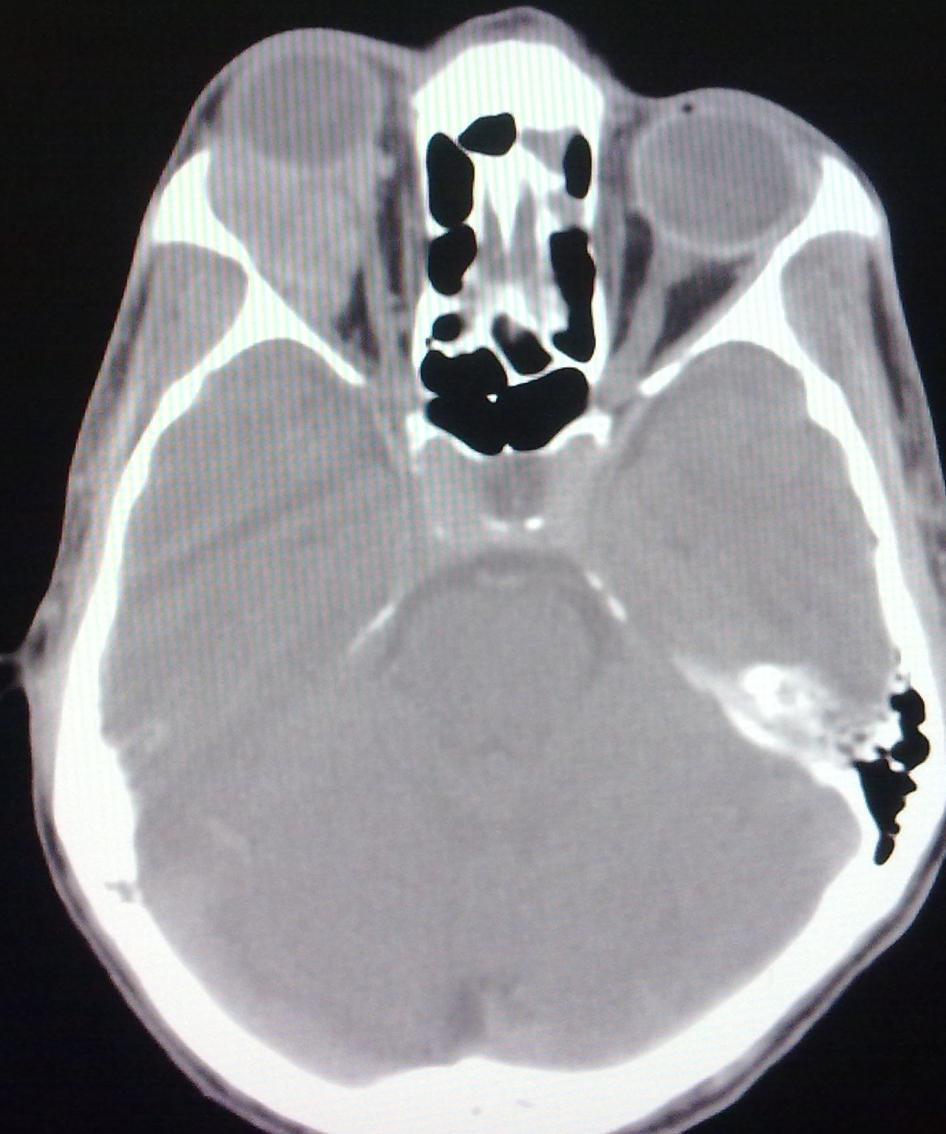 C3: CT scan brain and orbit Right retro-orbital mass causing