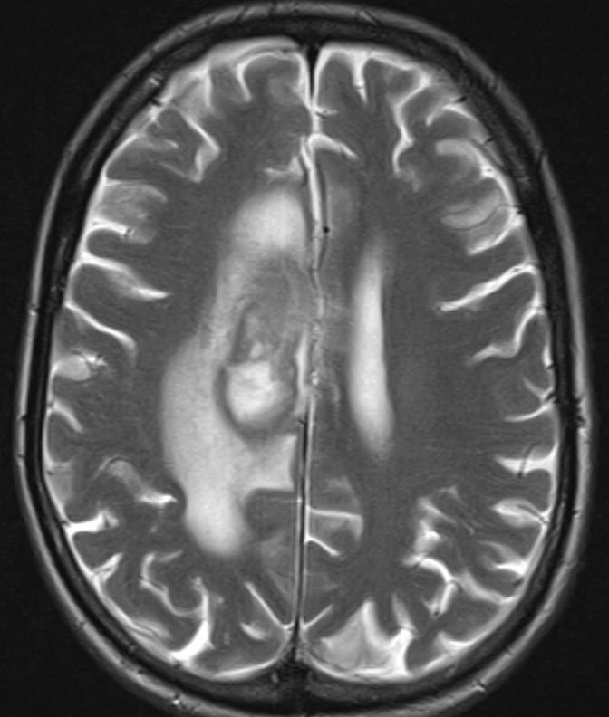 MRI White matter hyperintensities in the right
