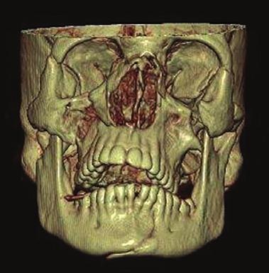 UNIVERSITY OF MIAMI MILLER SCHOOL OF MEDICINE Division of Oral & Maxillofacial Surgery Presents 2017-2018 WEBINARS: Grand Rounds in Oral & Maxillofacial Surgery OCTOBER 2017 - APRIL 2018 This unique