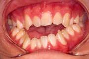 teeth, TMJ, muscles of mastication Dry mouth Soft