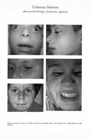 Tuberous Sclerosis Complex (TSC) The tumors are not
